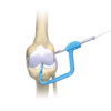 OutIn® - Instrumental for Anatomic Ligament Reconstruction