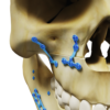 Osteotomia para aumento da maxila