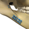 Osteotomia para aumento da mandíbula