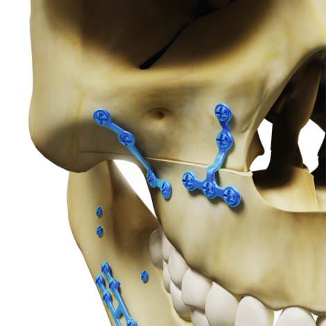 Osteotomia para aumento da maxila