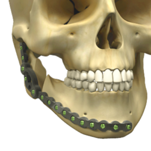 Reconstrução Mandibular